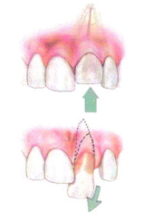 Dislodged Tooth